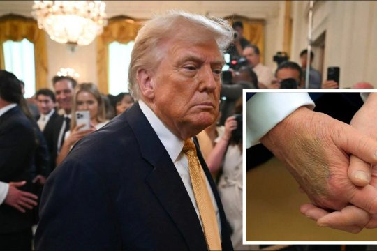 Cu ce probleme de sănătate se confruntă Donald Trump, de fapt. Casa Albă a făcut anunțul în urmă cu puțin timp